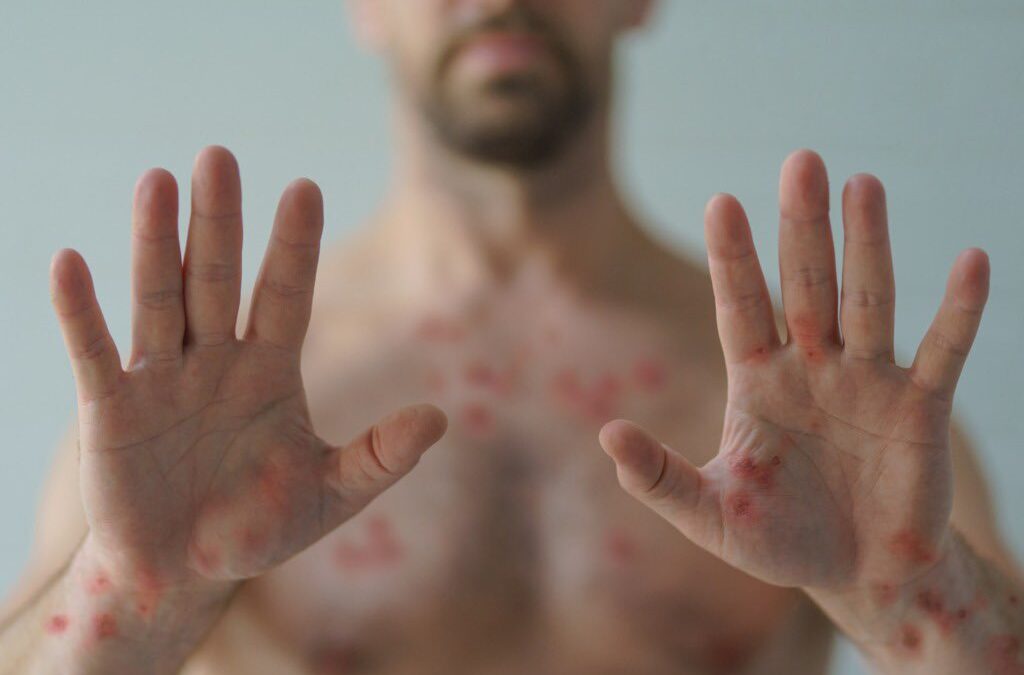 CRECE EL NÚMERO DE AFECTADOS POR LA VIRUELA DEL MONO EN NUESTRO PAÍS